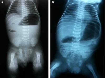 T-tube enterostomy in the management of apple-peel atresia: A case series from a single center